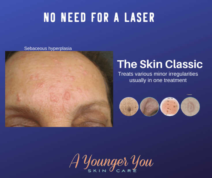 A Younger You offers sebaceous hyperplasia with skin classic